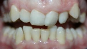 điều trị răng cắn sâu cung hàm lệch lạc với khay niềng K Clear