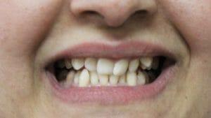 điều trị răng cắn sâu cung hàm lệch lạc với khay niềng K Clear
