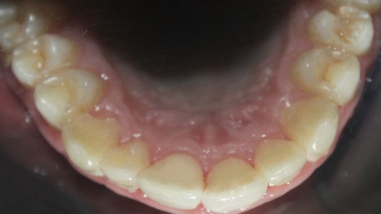 điều trị răng chen chúc với khay niềng răng K Clear của K Line