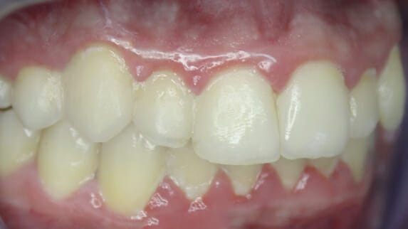 điều trị răng chen chúc với khay niềng răng K Clear của K Line